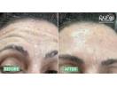 Professional Botox in Bangalore for Smooth & Youthful Appearance